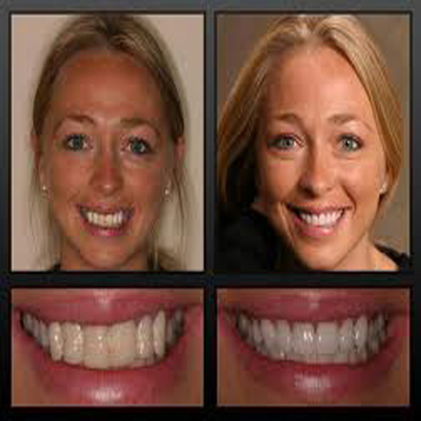 Porcelain Veneers